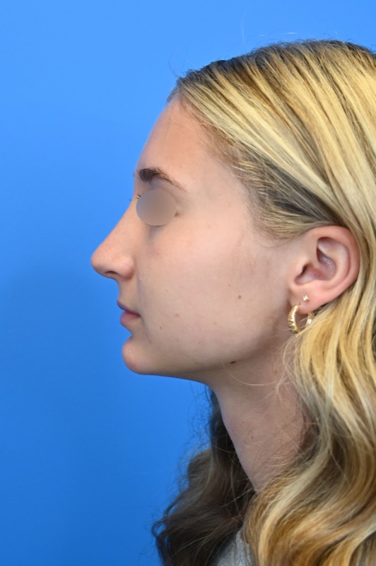 Rhinoplasty Before & After Image