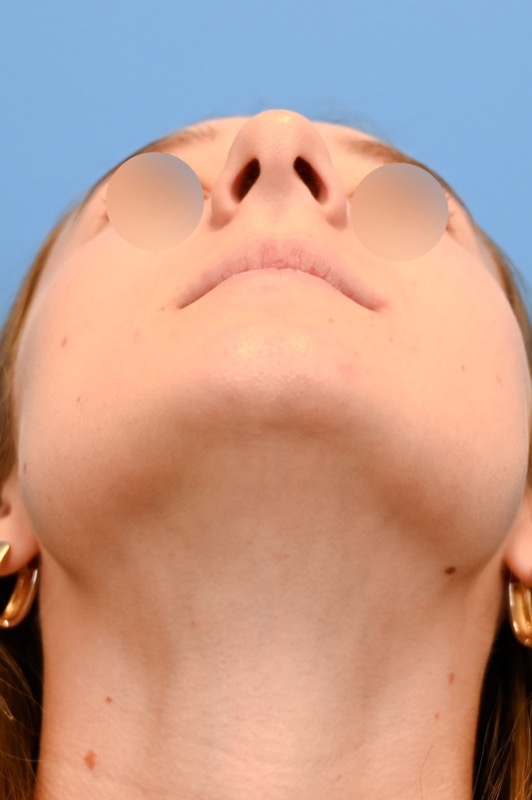 Rhinoplasty Before & After Image