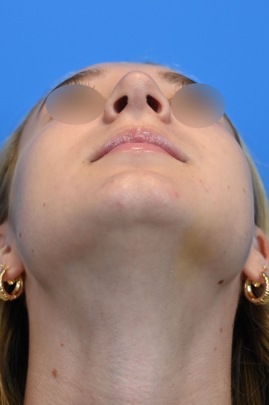 Rhinoplasty Before & After Image