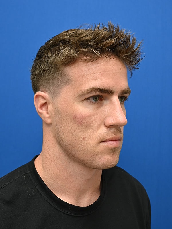 Rhinoplasty Before & After Image