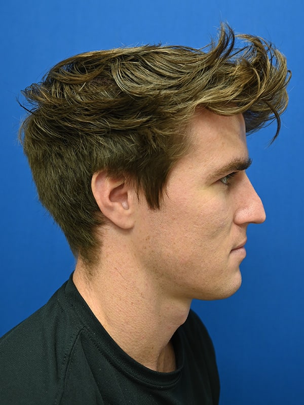 Rhinoplasty Before & After Image