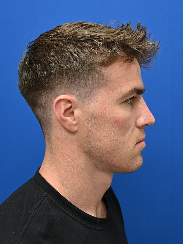 Rhinoplasty Before & After Image