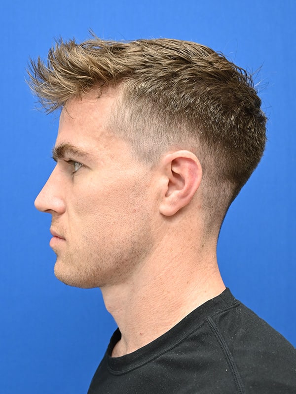 Rhinoplasty Before & After Image