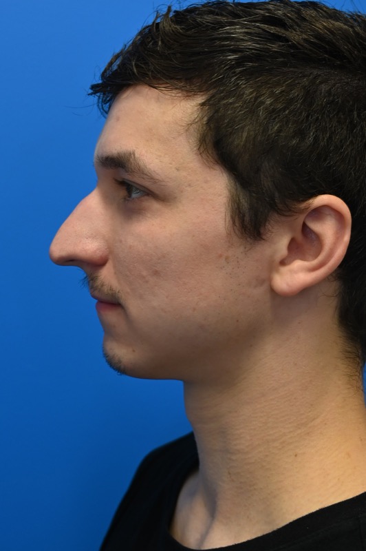 Rhinoplasty Before & After Image