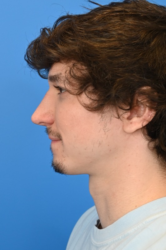 Rhinoplasty Before & After Image