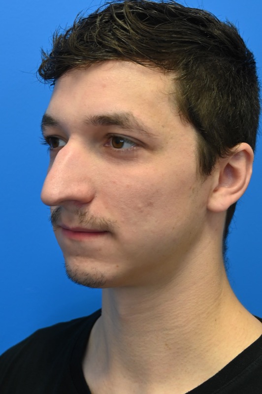 Rhinoplasty Before & After Image