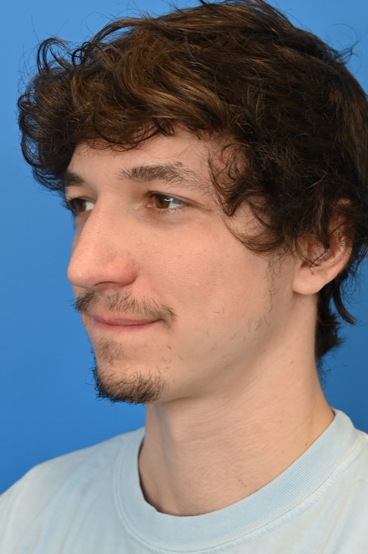 Rhinoplasty Before & After Image