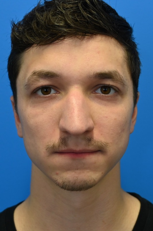 Rhinoplasty Before & After Image