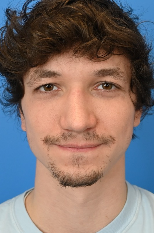 Rhinoplasty Before & After Image