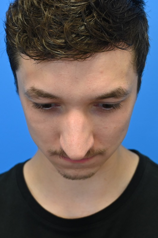 Rhinoplasty Before & After Image