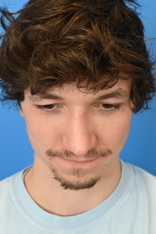 Rhinoplasty Before & After Image