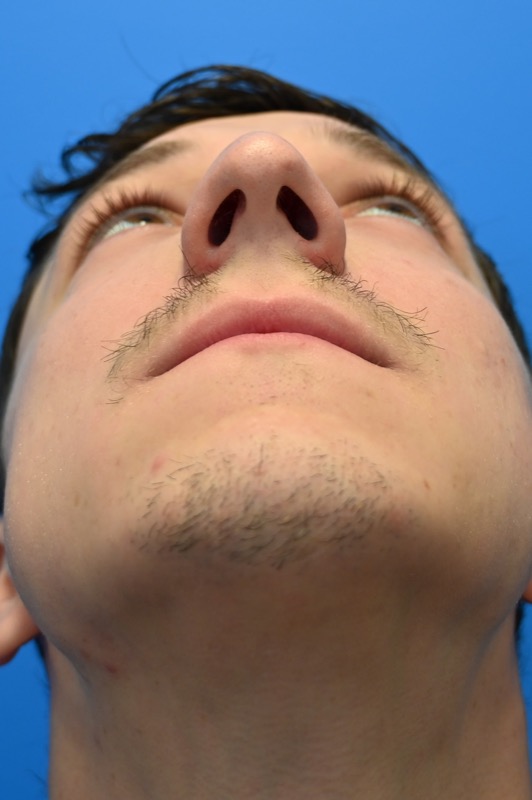 Rhinoplasty Before & After Image