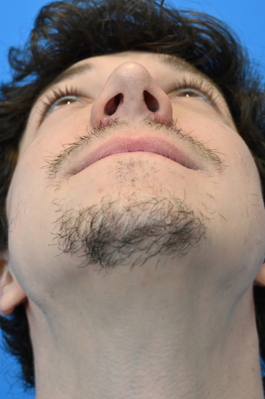 Rhinoplasty Before & After Image