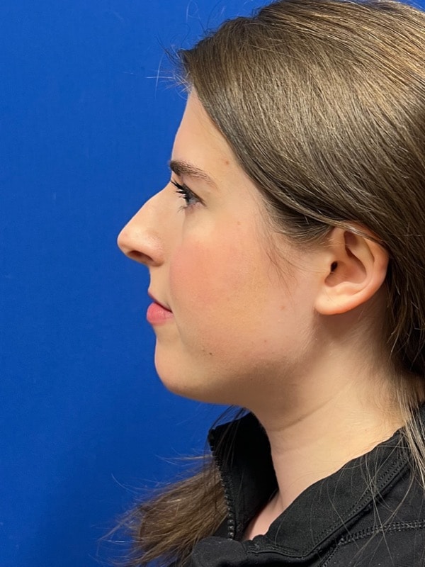 Rhinoplasty Before & After Image