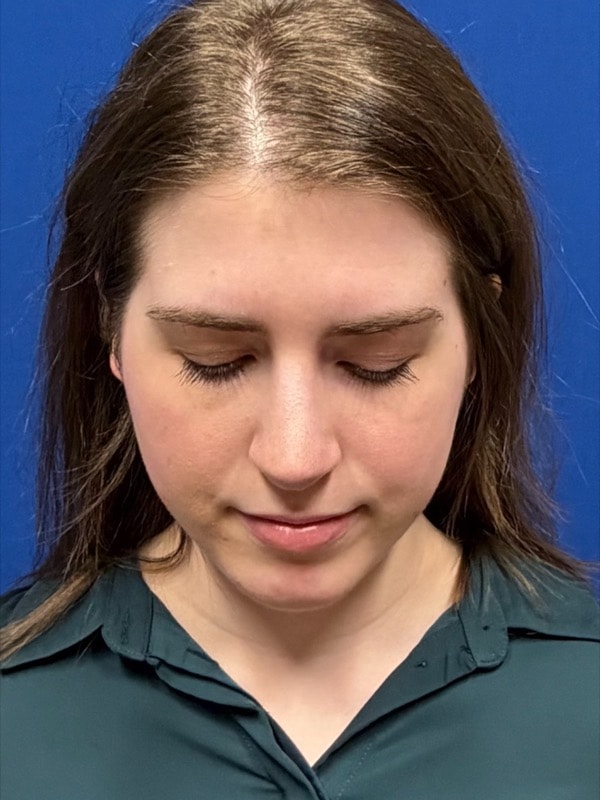 Rhinoplasty Before & After Image