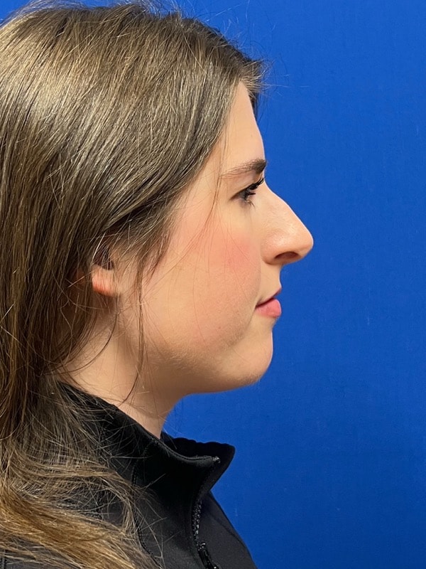 Rhinoplasty Before & After Image