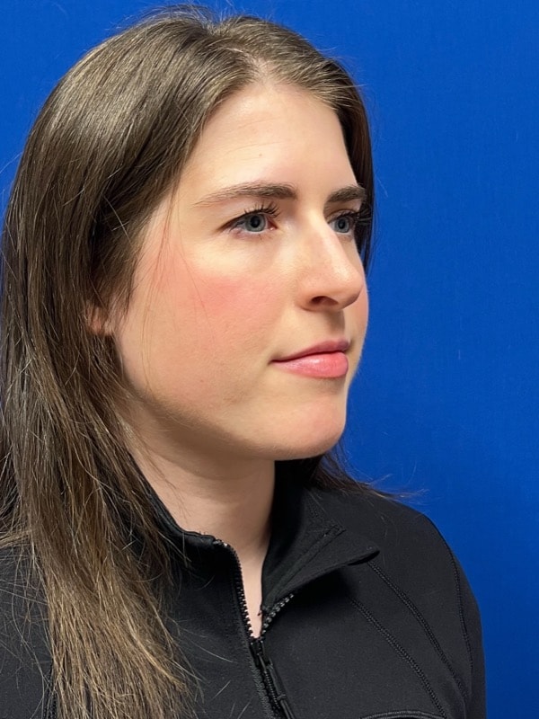 Rhinoplasty Before & After Image