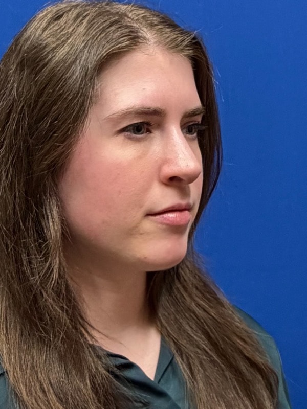 Rhinoplasty Before & After Image