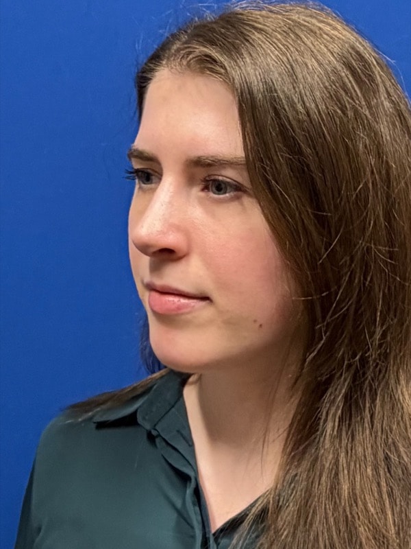 Rhinoplasty Before & After Image