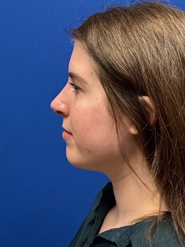 Rhinoplasty Before & After Image
