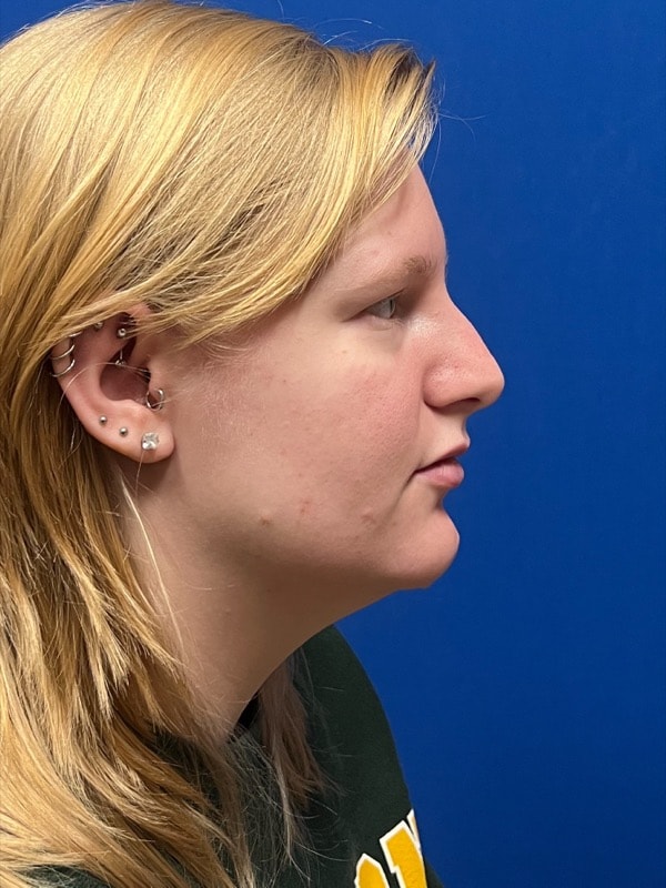 Rhinoplasty Before & After Image