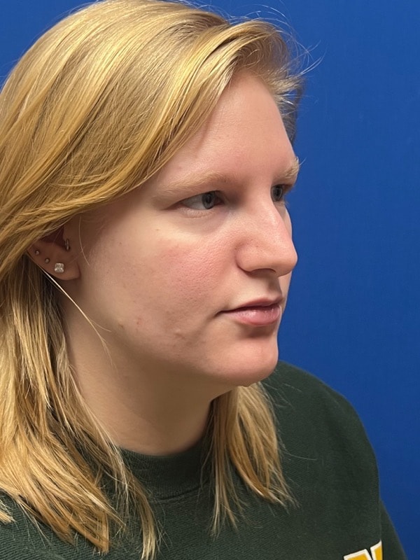 Rhinoplasty Before & After Image