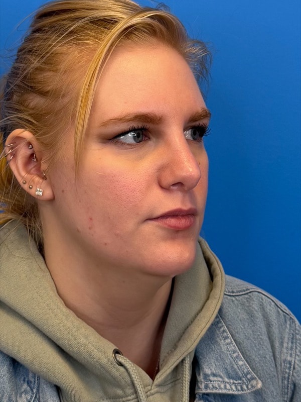 Rhinoplasty Before & After Image