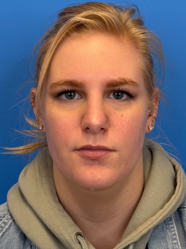 Rhinoplasty Before & After Image