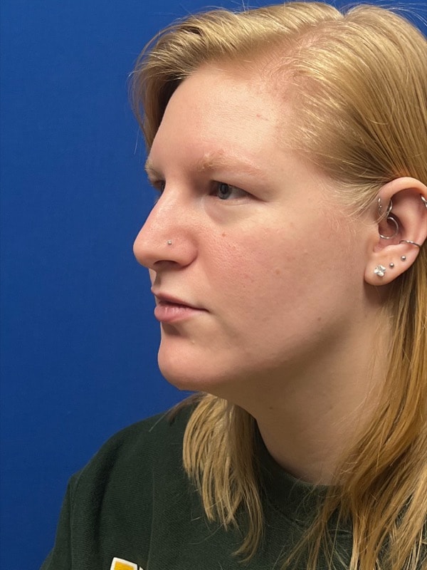 Rhinoplasty Before & After Image