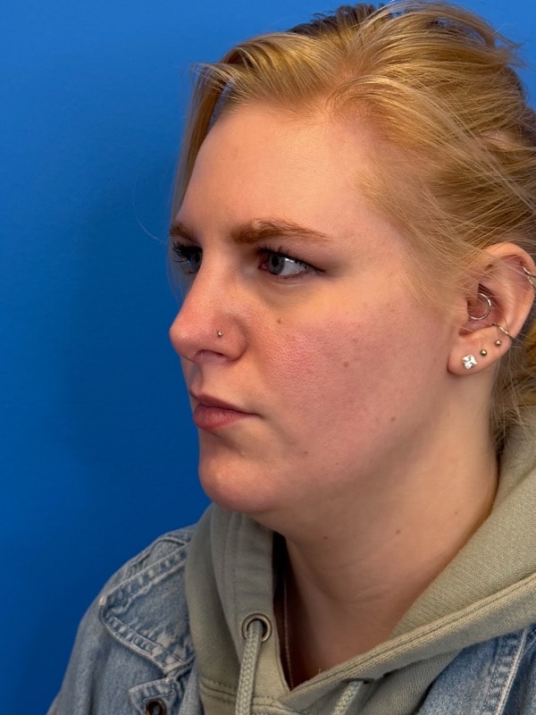 Rhinoplasty Before & After Image