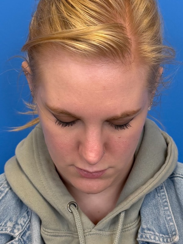 Rhinoplasty Before & After Image