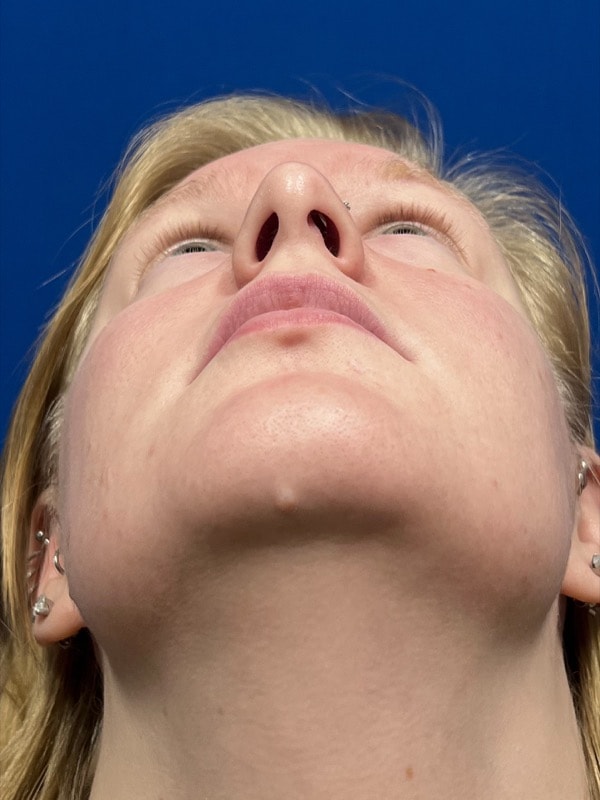 Rhinoplasty Before & After Image