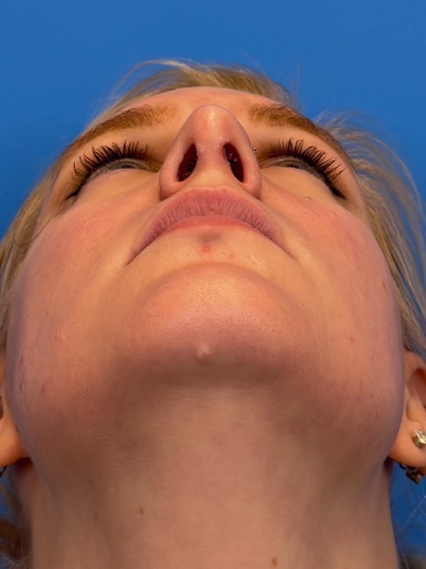 Rhinoplasty Before & After Image