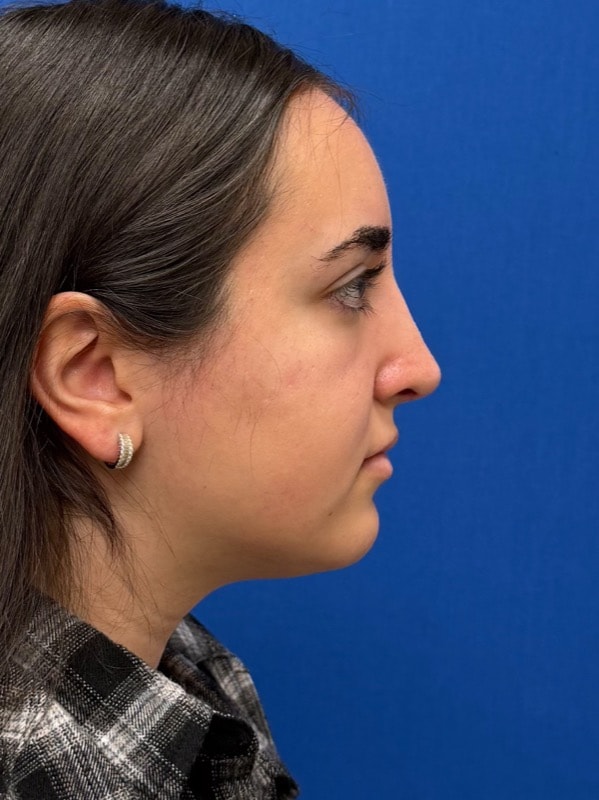 Rhinoplasty Before & After Image