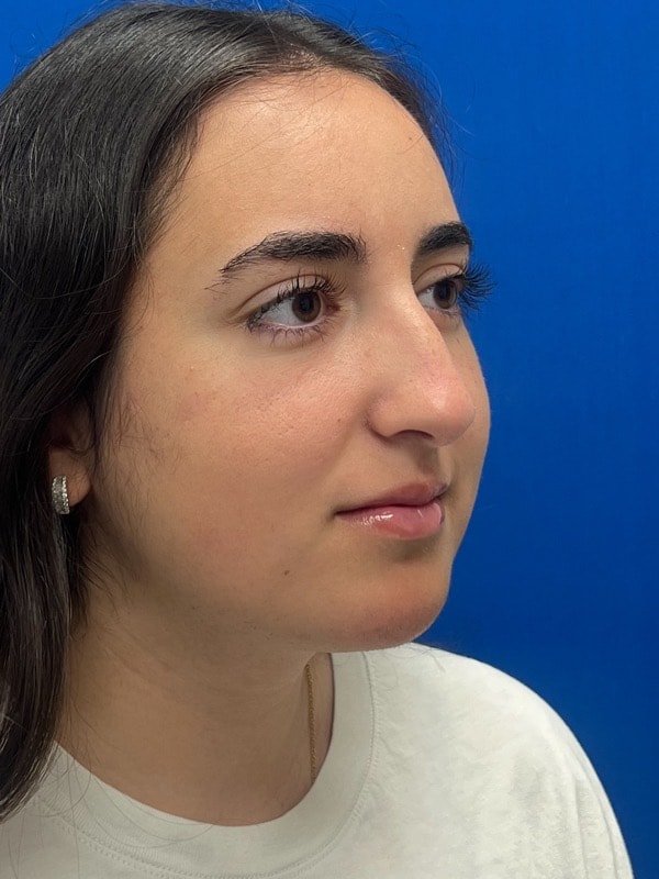 Rhinoplasty Before & After Image