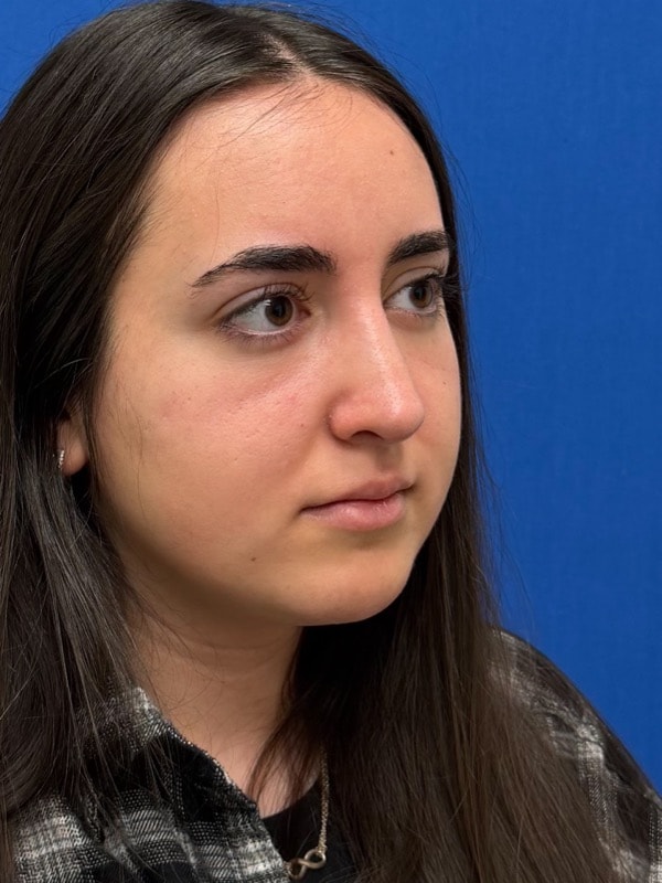 Rhinoplasty Before & After Image