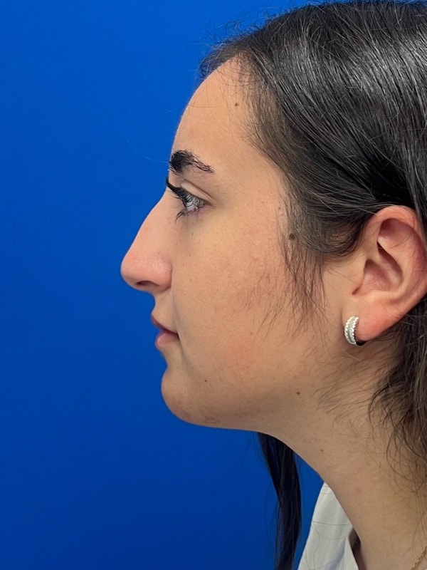Rhinoplasty Before & After Image