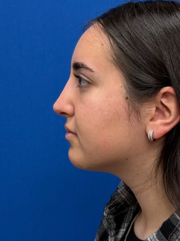 Rhinoplasty Before & After Image