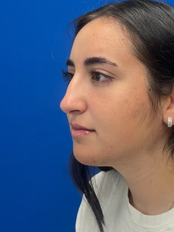 Rhinoplasty Before & After Image