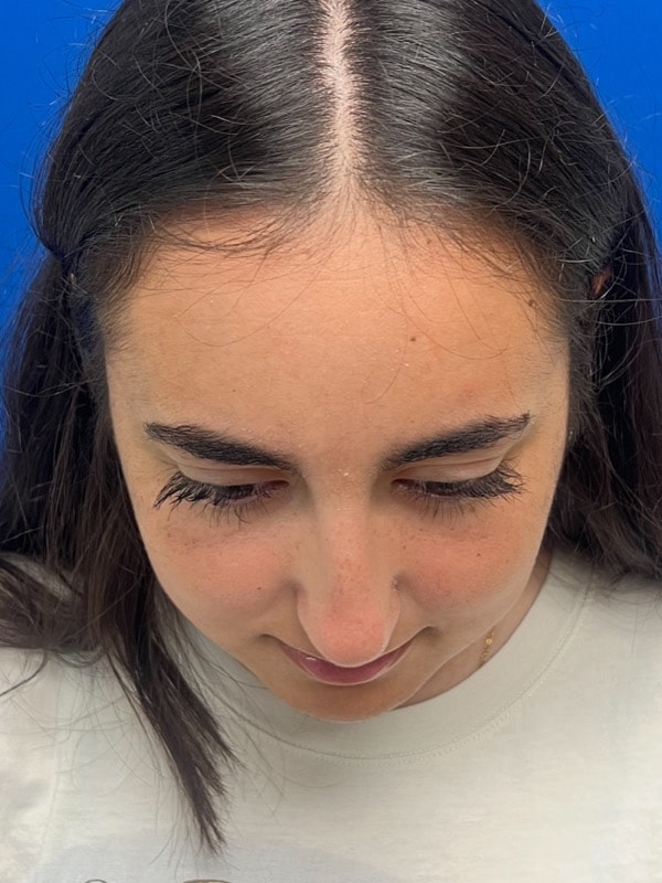 Rhinoplasty Before & After Image