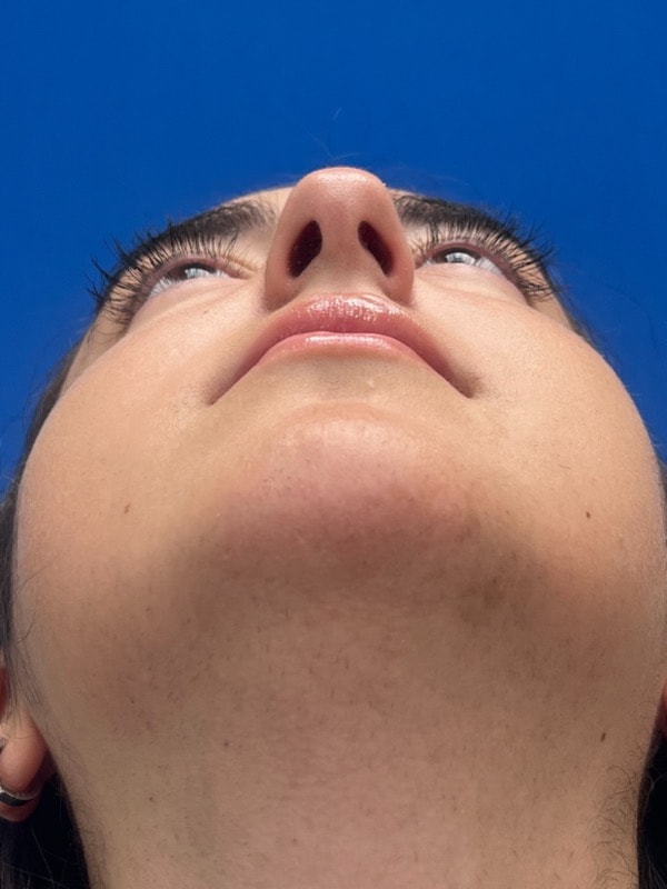 Rhinoplasty Before & After Image