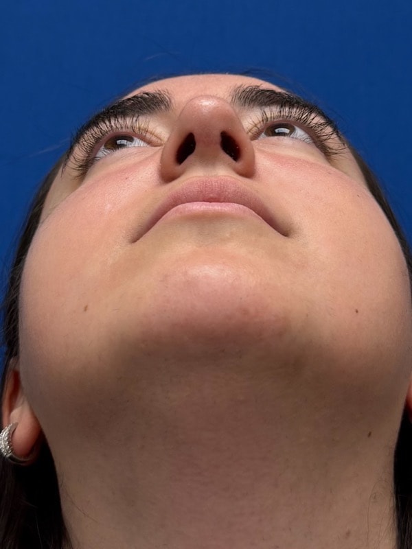 Rhinoplasty Before & After Image