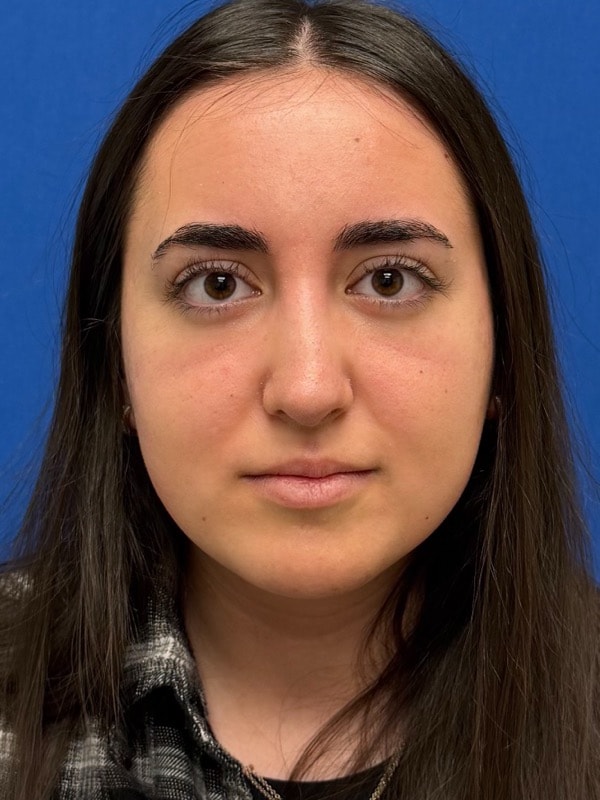 Rhinoplasty Before & After Image