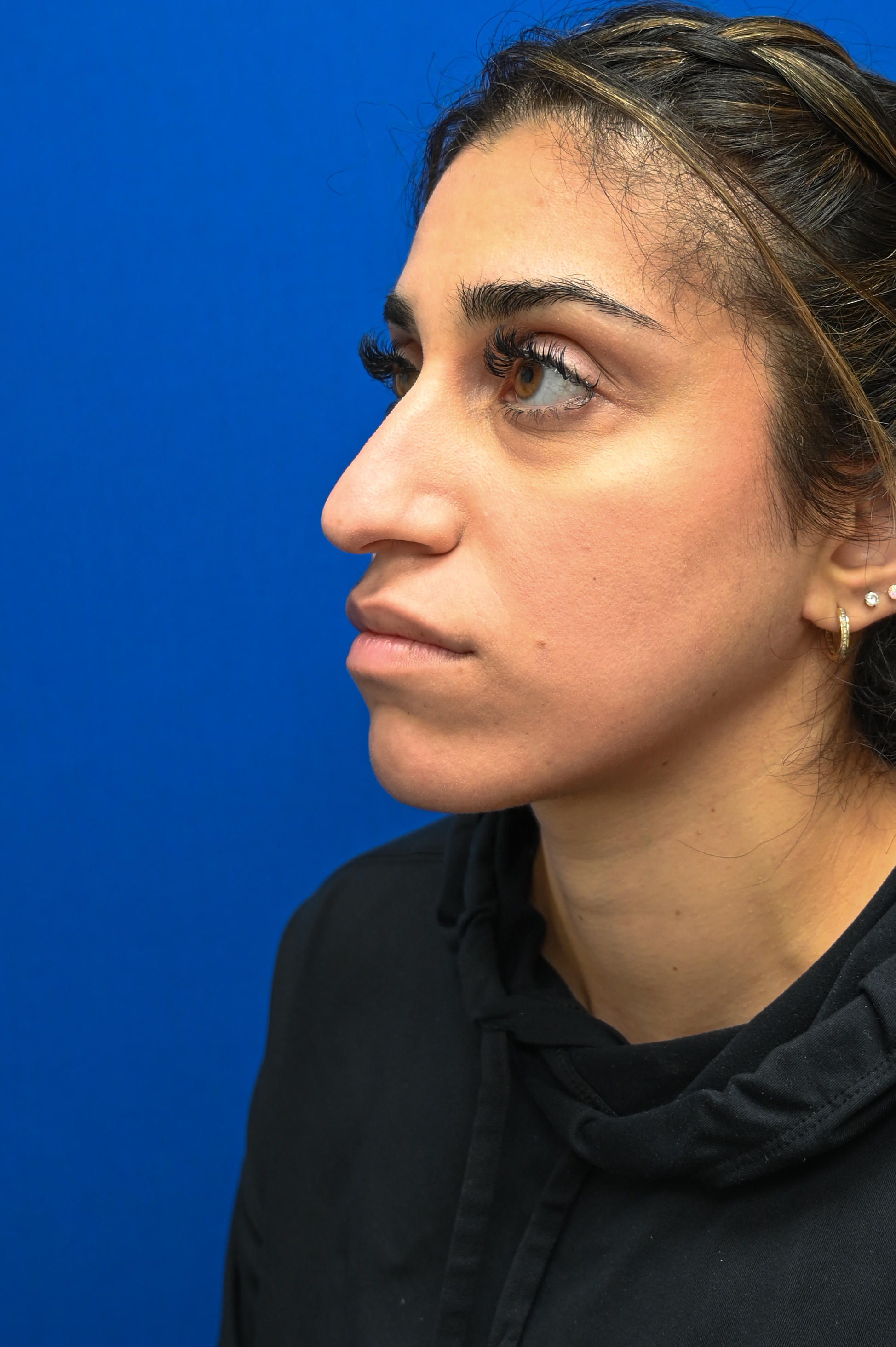 Rhinoplasty Before & After Image