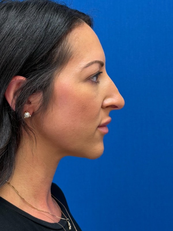 Rhinoplasty Before & After Image
