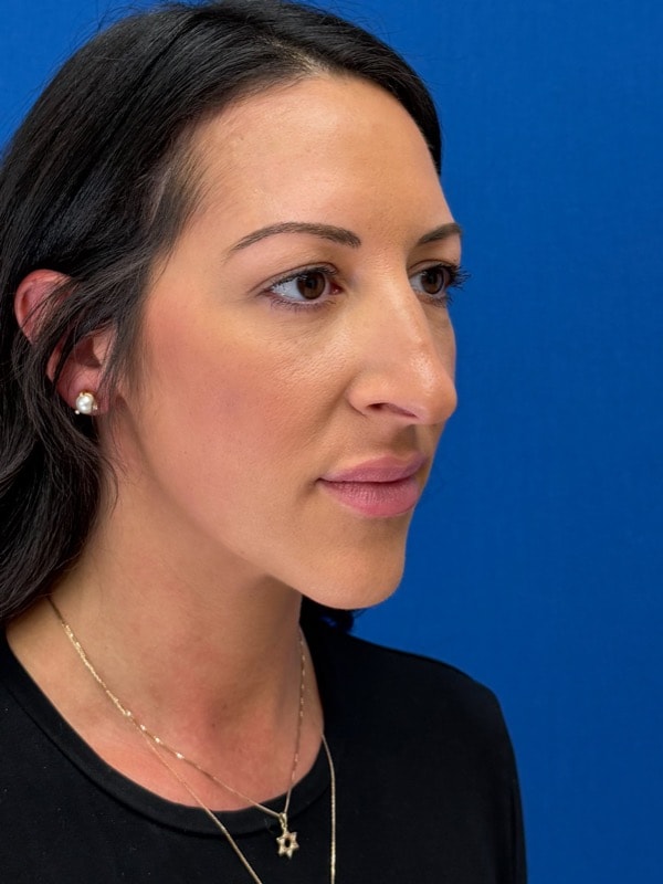 Rhinoplasty Before & After Image