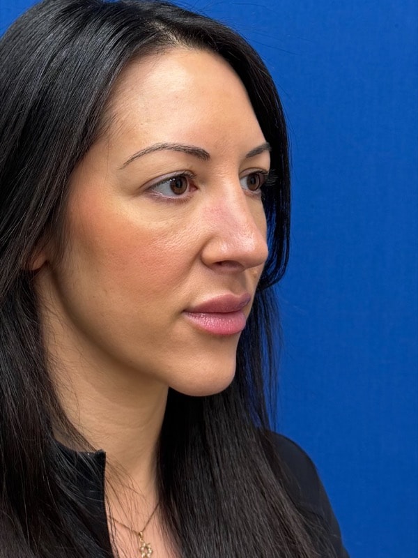 Rhinoplasty Before & After Image