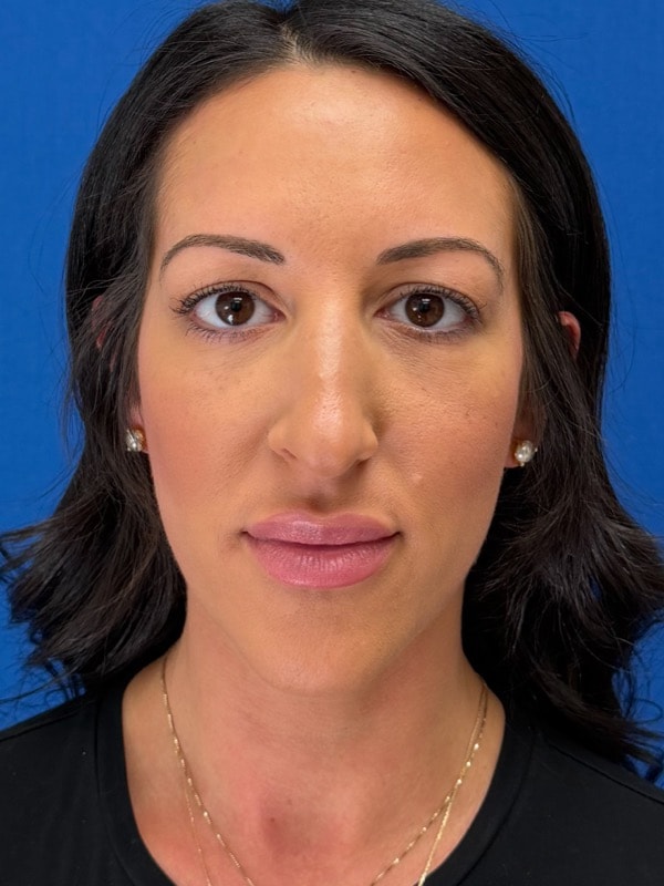 Rhinoplasty Before & After Image