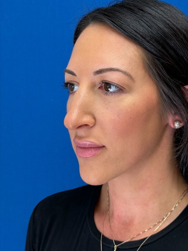 Rhinoplasty Before & After Image