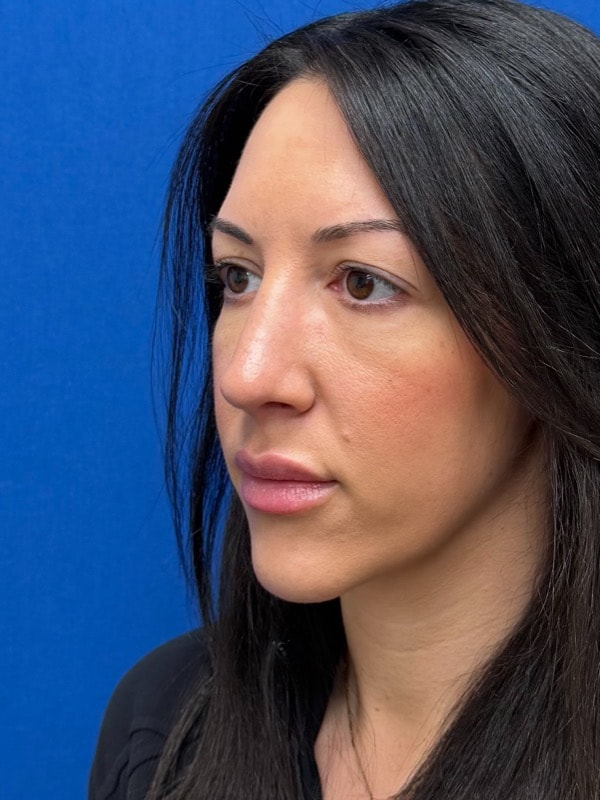 Rhinoplasty Before & After Image